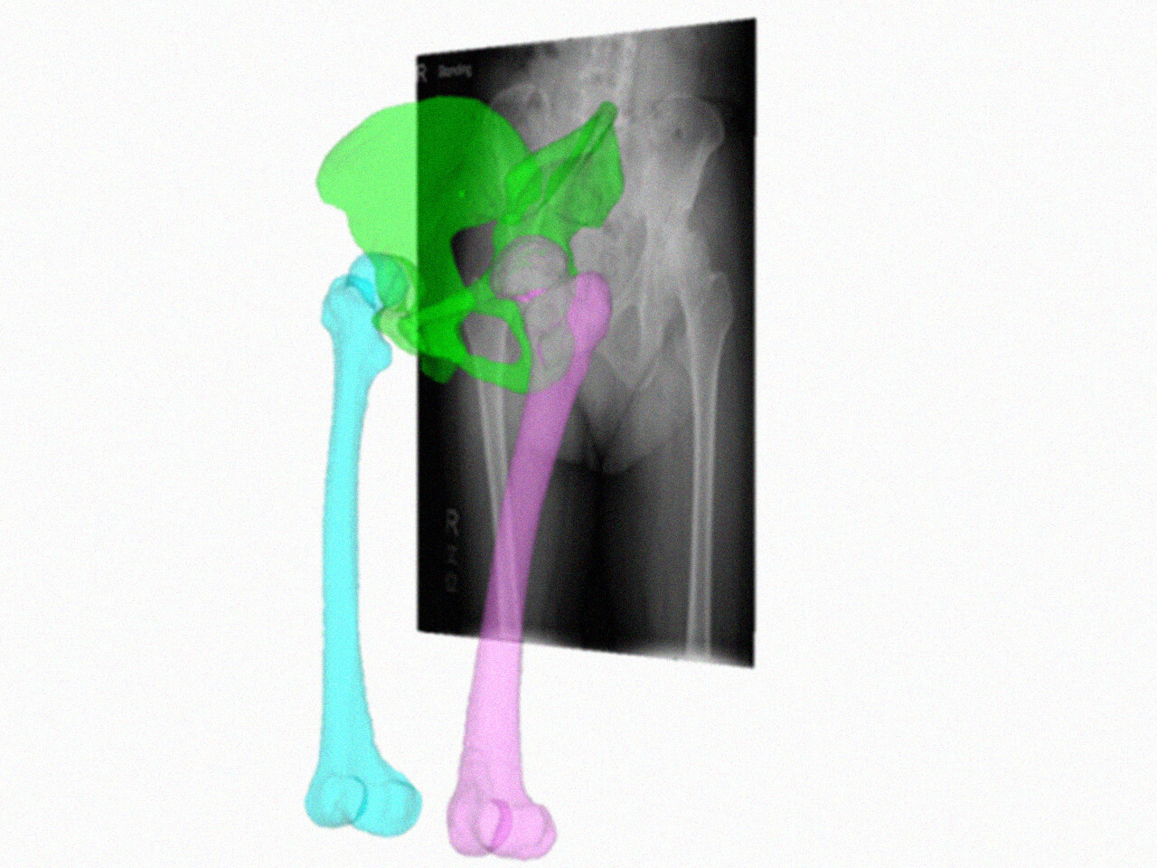 Hip Joint Surgery